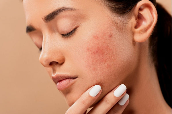 Battling Redness